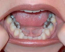 Amalgámové výplně v ústech pacienta