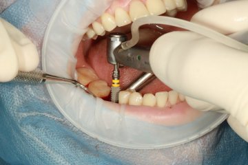 III. Výhody a nevýhody zubních implantátů
