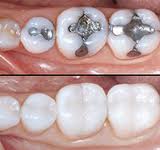II. Přímé zubní výplně