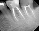 IV. Endodontické ošetření