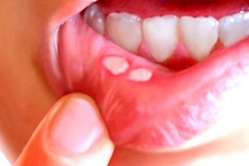 Afty – časté a bolestivé postižení ústní sliznice