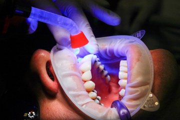 Světlo používané zubaři zpomaluje nádory?