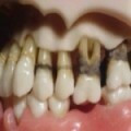 III. Parodontitida - "parodontóza"