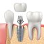 Zubní implantáty