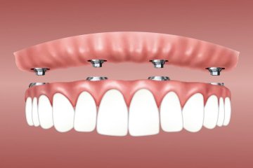 Zubní implantáty