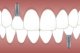 II. Indikace a kontraindikace zubních implantátů