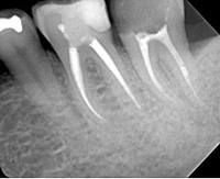 IV. Endodontické ošetření