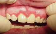 II. Gingivitida - zánět dásní