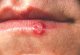Lidstvo versus virus Herpes simplex