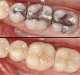 I. Zubní výplně - základní informace